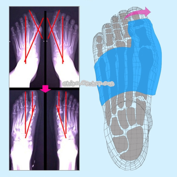 Foot Thumb Valgus Foot Bone Type Orthopedic Shoes Valgus Thumb Inflatable Toe Orthosis